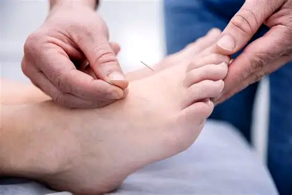 Acupuncture treatment on the foot