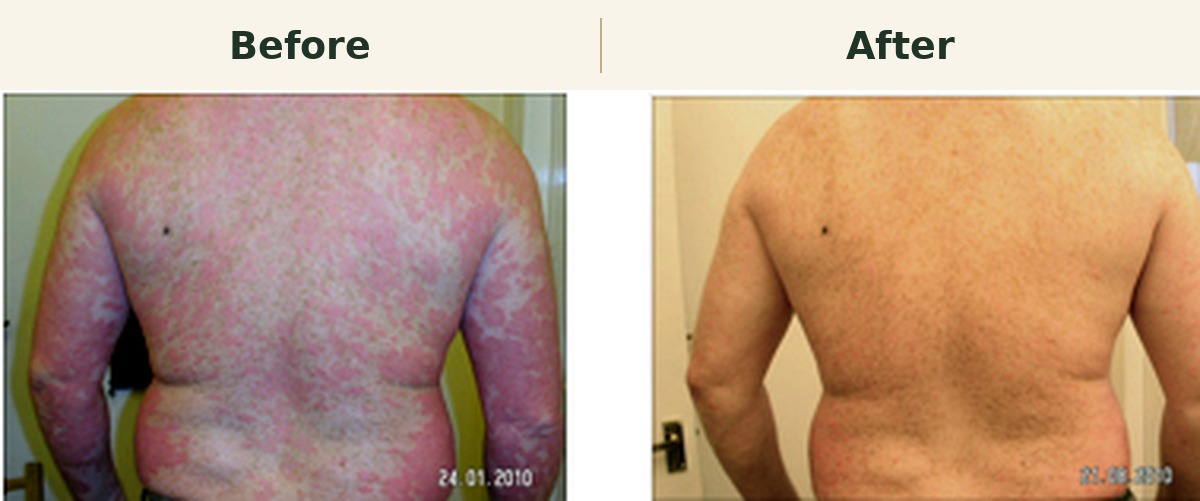 Before and after treatment comparison on two backs