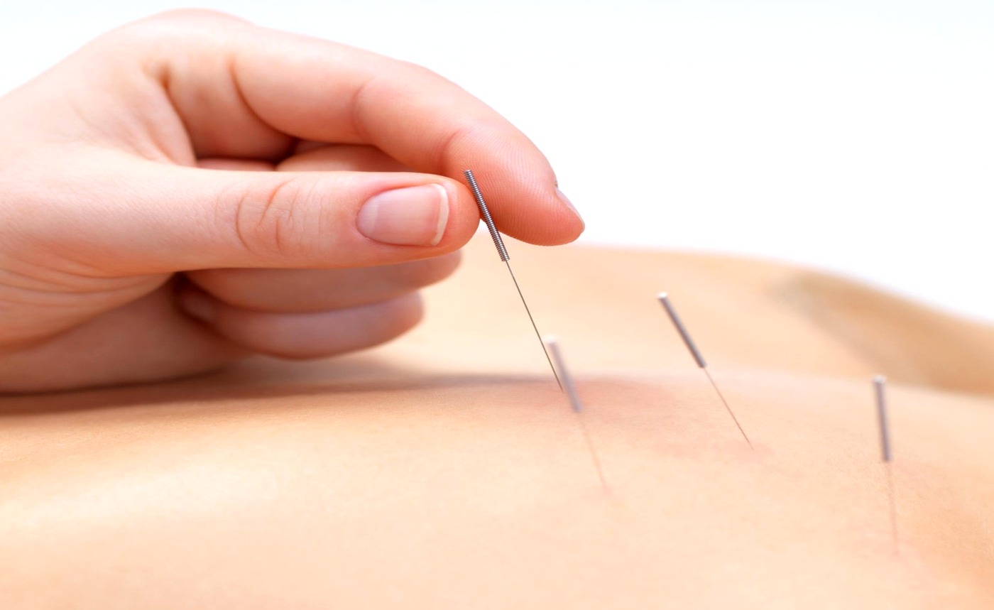 Close-up acupuncture needle treatment