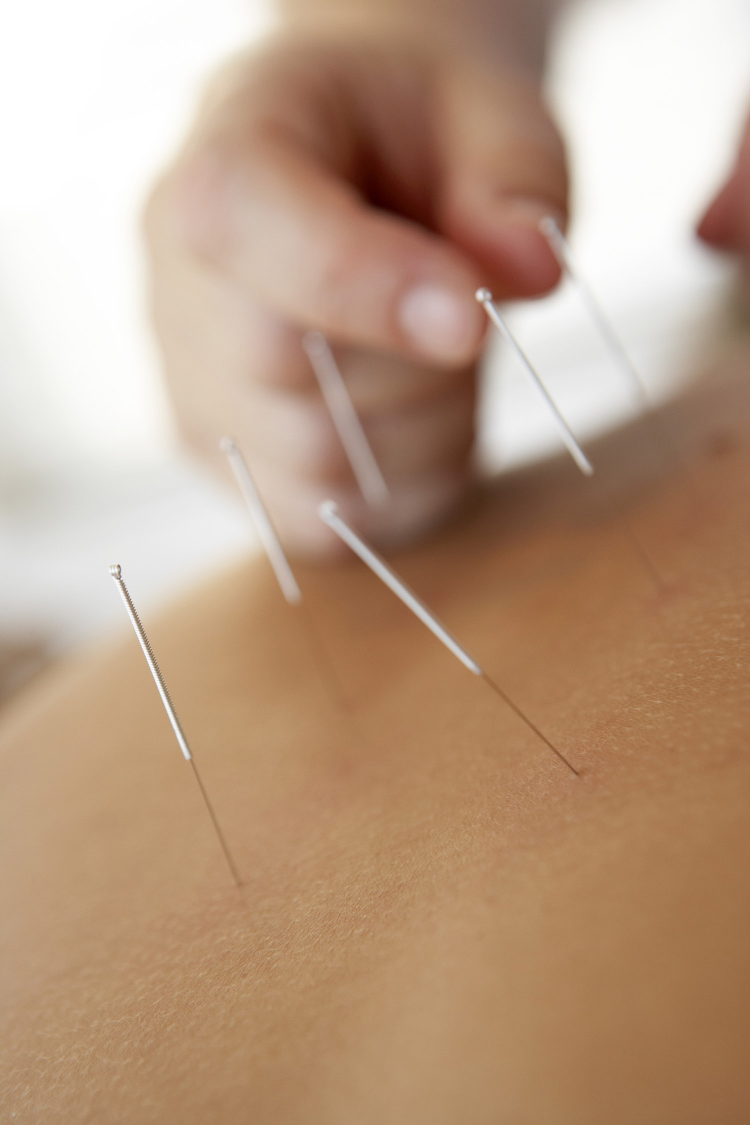 Cupping treatment on a patient’s back